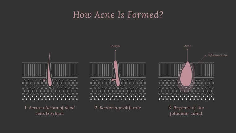 How Does Pore Size Change Over Time? Can We Shrink Large Pores? 3-2