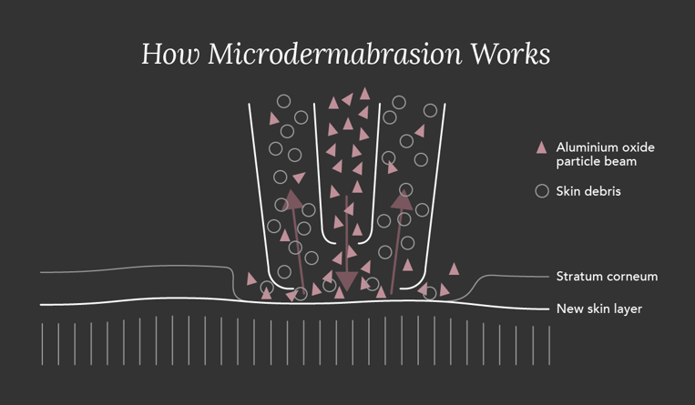 How Microdermabrasion Works