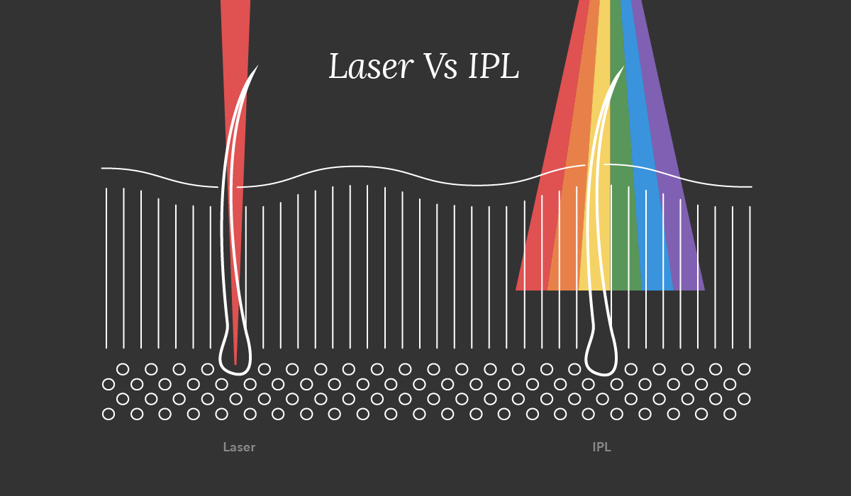 Laser VS IPL