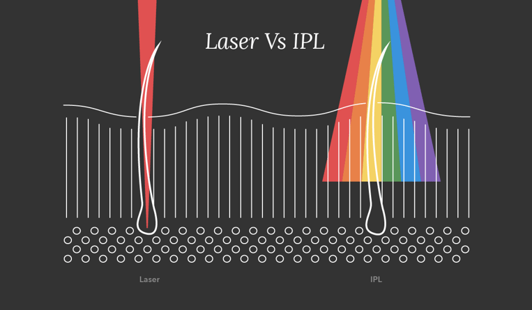 Laser VS IPL 