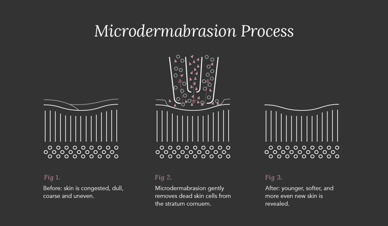 Microdermabrasion Process