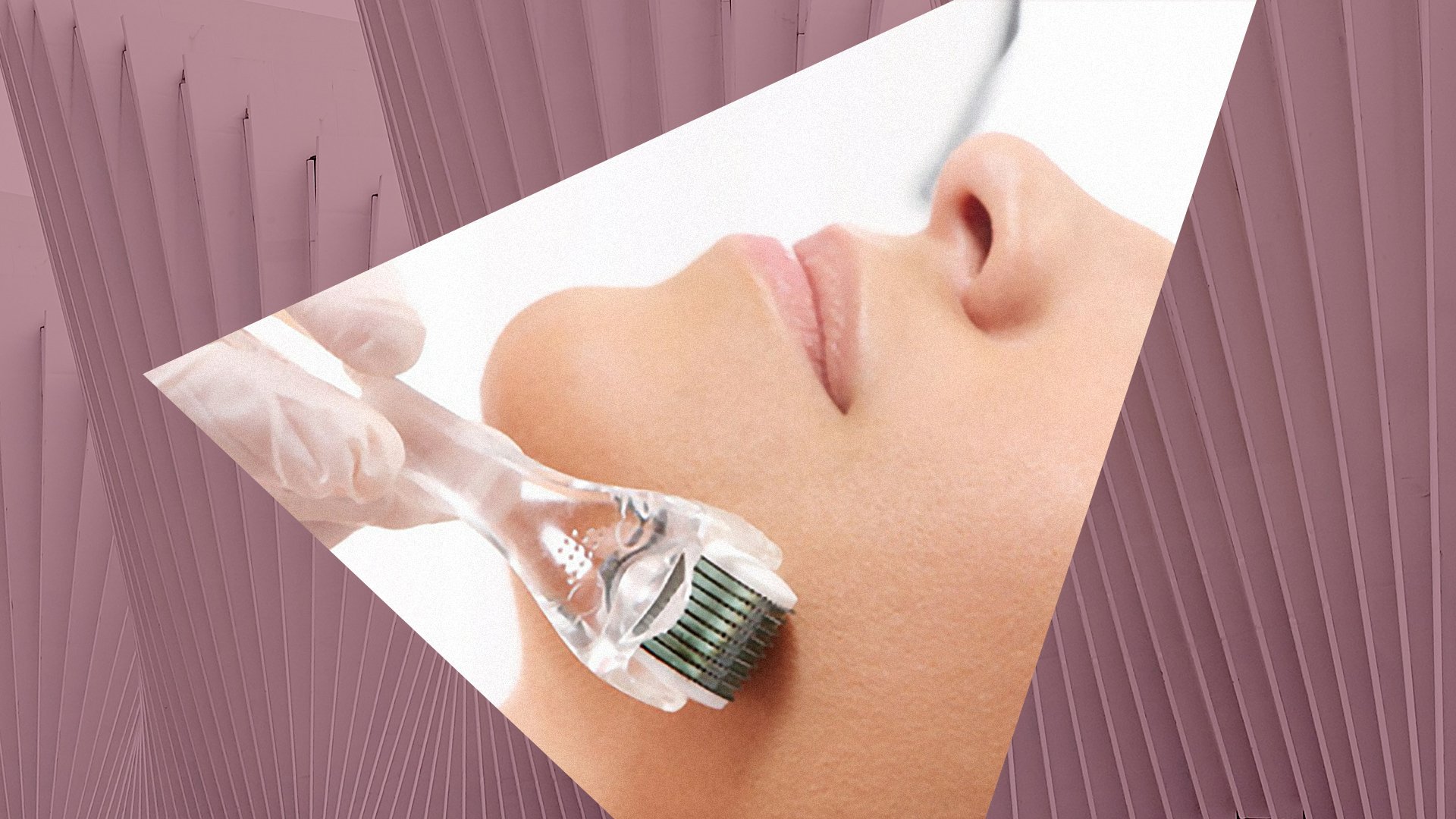 Microneedling 101 - Benefits for Your Skin