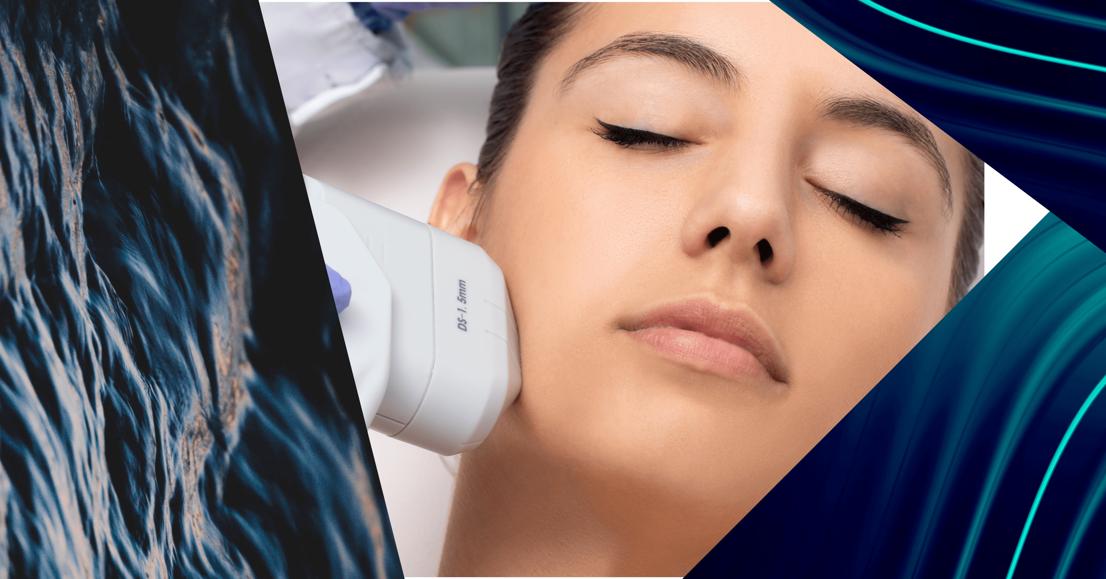 RF vs HIFU: What’s the Difference?
