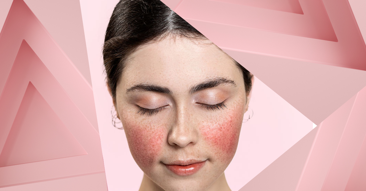 Quick Home Remedies for Rosacea